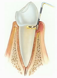 Zahnarzt Aarau: Taschentiefenmessung bei Parodontitis