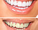 Cosmetic dentistry - Zähnebleichen